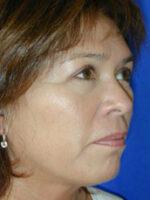 Facelift