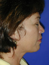 Facelift