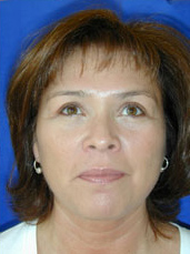 Facelift