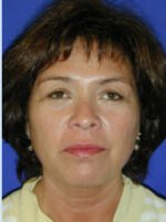 Facelift