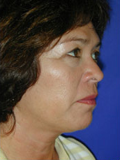Facelift