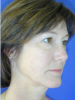 Facelift