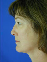 Facelift