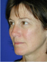 Facelift