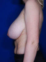 Breast Lift