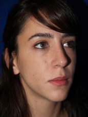 Rhinoplasty