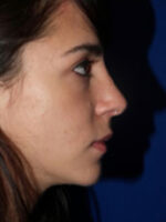 Rhinoplasty