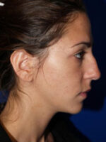 Rhinoplasty