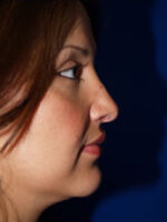 Rhinoplasty