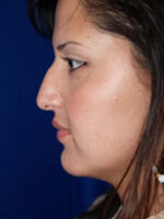 Rhinoplasty