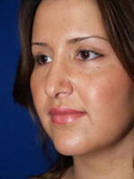 Rhinoplasty