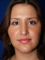 Rhinoplasty