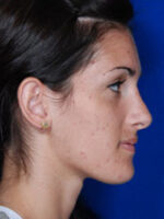 Rhinoplasty