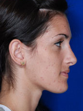 Rhinoplasty