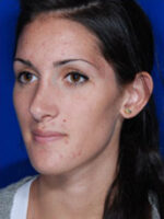 Rhinoplasty