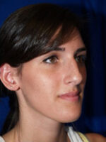Rhinoplasty