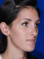 Rhinoplasty