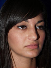 Rhinoplasty