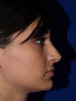 Rhinoplasty