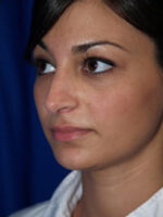 Rhinoplasty