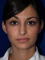Rhinoplasty