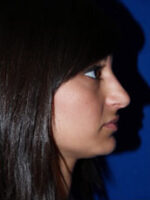 Rhinoplasty