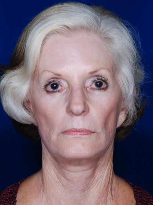 Facelift