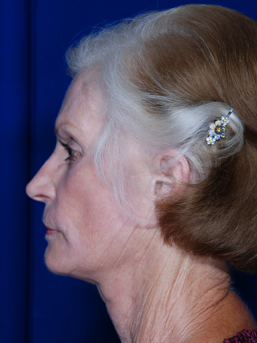 Facelift