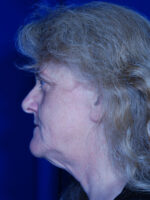 Facelift