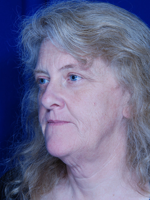 Facelift