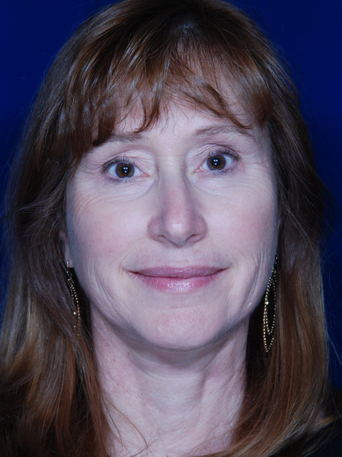Facelift