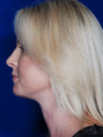 Facelift