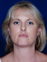Facelift