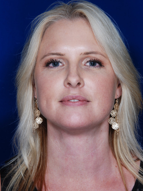 Neck Lift