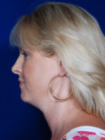 Facelift