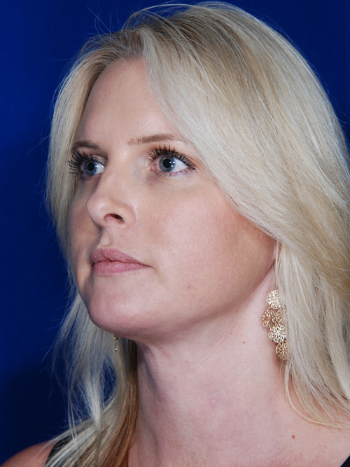 Facelift