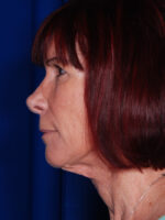 Facelift