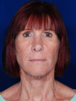 Facelift