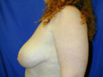 Breast Lift