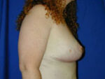Breast Lift