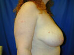 Breast Lift
