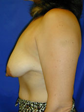 Breast Lift