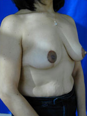 Breast Lift