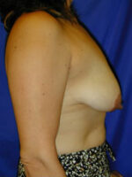 Breast Lift