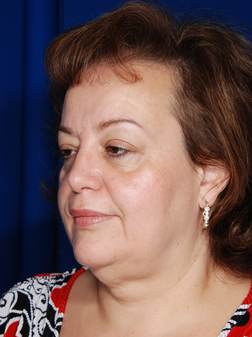 Facelift