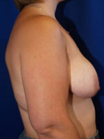 Breast Lift