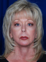 Facelift