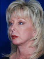 Facelift