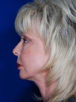 Facelift