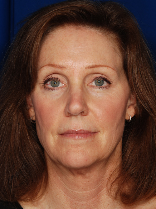 Facelift
